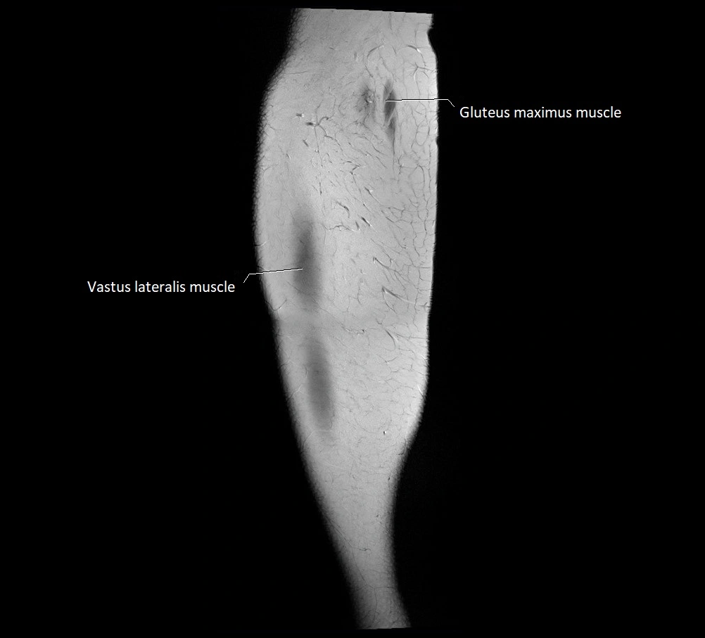 Thigh sagittal cross sectional anatomy MRI 3T image 1.webp
